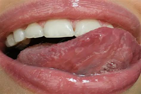 Infección en lengua: Causas, síntomas y más - P&P Clinic