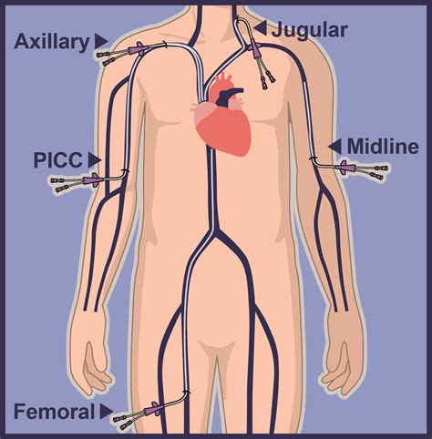 Central Venous Catheter Lines | Vascular Wellness