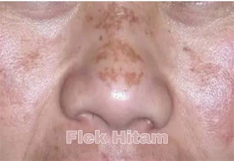 penyebab flek  wajah berikut mengatasinya