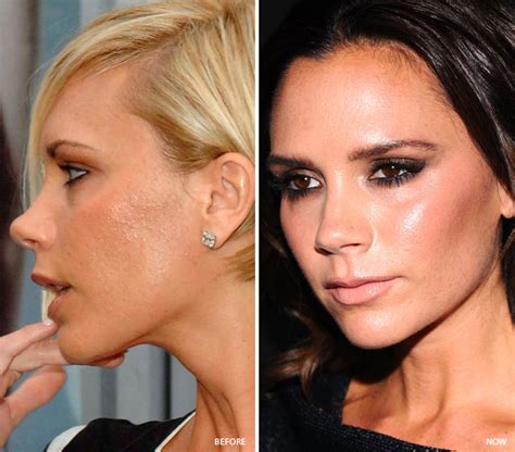 8 Celebrities Who Fixed Their Skin Problems - NewBeauty