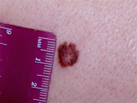 What’s new in the latest melanoma guidelines | MDedge Dermatology