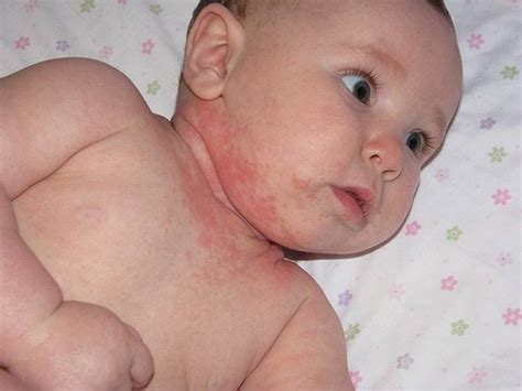 Seborrheic Dermatitis Scalp Infant