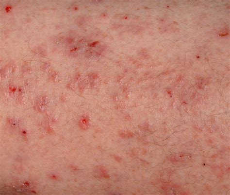 The Scabies Rash and Other Scabies Symptoms to Watch For - Riverchase ...