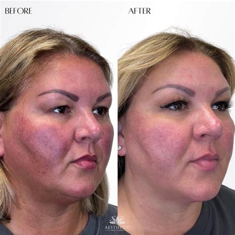 Before & After BBL Laser Highland Park | Aesthetic Beauty Lounge