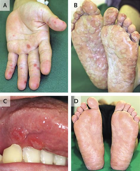 Hand Foot And Mouth In Adults Quarantine at Harold Spence blog