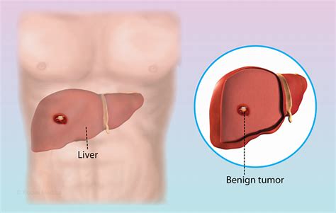 Health Condition : Symptoms, Causes, Treatment and More