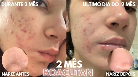Roacutan Mês A Mês Fotos - 2º MÊS ROACUTAN | Diário Roacutan - YouTube