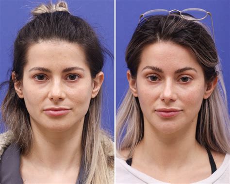 patient  temple lift    dr fechner