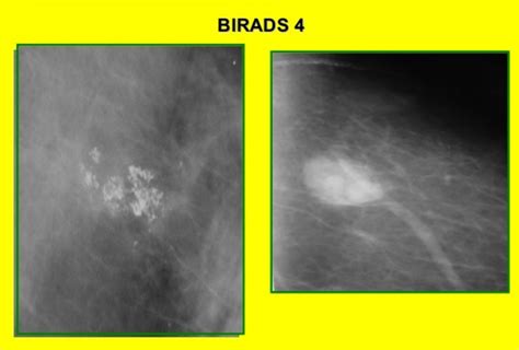 Birads классификация — 24Radiology.ru