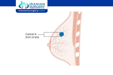 Stage 1 breast cancer | Treatment for breast cancer stage 1