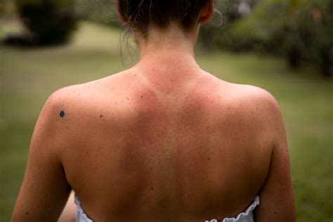 mengenal kondisi sun poisoning kerusakan kulit parah akibat paparan