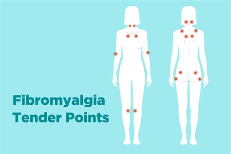 Fibromyalgia Diagnosis: Understanding the Criteria and Process