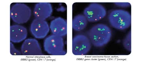 The Her-2/Neu (Erbb2) Oncogene In Breast Cancer: Prognostic Factor ...