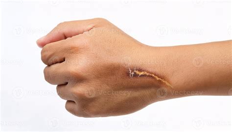 Macro view of a circular scar from a cigarette burn on the wrist