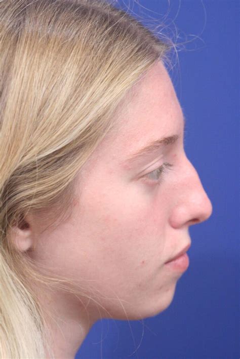 Rhinoplasty | Nose Surgery Near Me