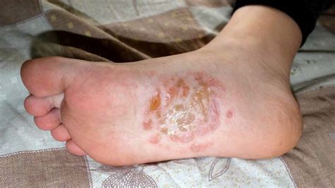 Eczema Blisters: Types, Causes, and Treatments