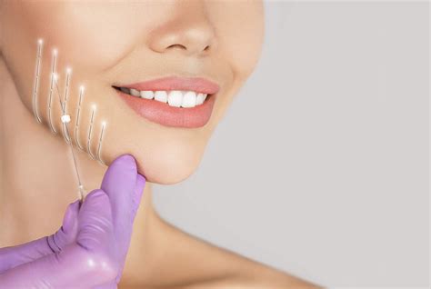 fili  trazione lifting  fili costo benefici procedura