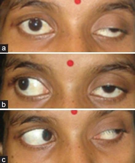 Third nerve palsy - WikEM