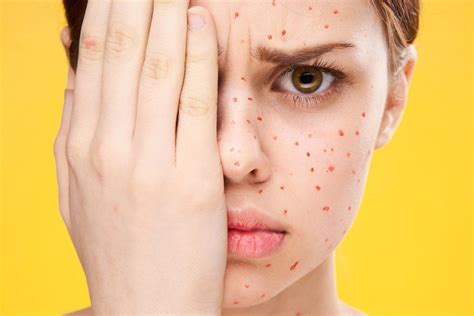 bisakah terkena cacar dua   faktanya klikdokter