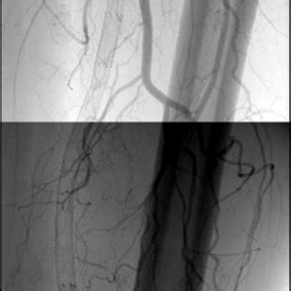 (PDF) Stent fractures after superficial femoral artery stenting