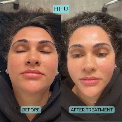 hifu face age  ronnie baker blog