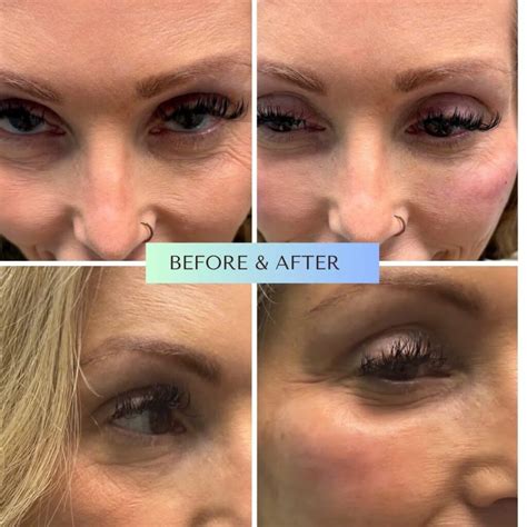 eye prp treatment natural eye rejuvenation serene med spa