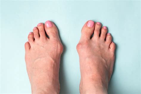 bunion deformities  mill creek wa mill creek foot ankle clinic
