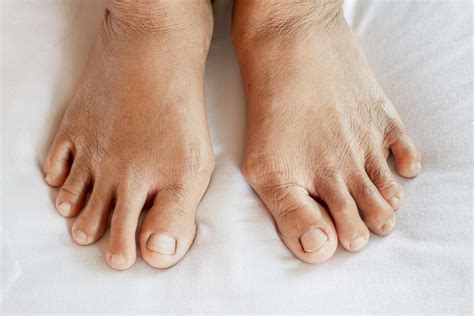 early signs  arthritis  feet