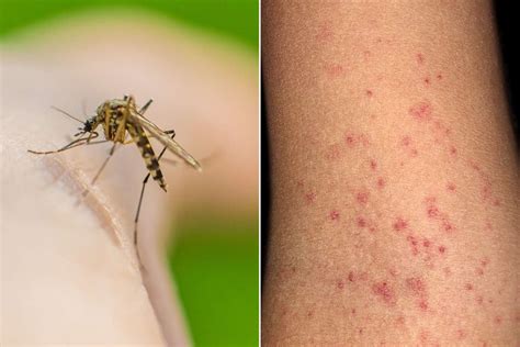 cdc warns  increased risk  dengue fever