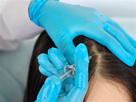PRP For Hair Loss