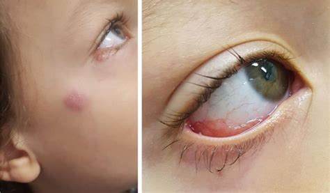 Esporotricose No Olho Humano - Envolvimento ocular na esporotricose: relato de dois casos em crianças ...