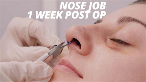 Rhinoplasty Vlog Part 2 - Splint Removal and Nose Job Recovery (1 WEEK POST OP) - Клиника ...