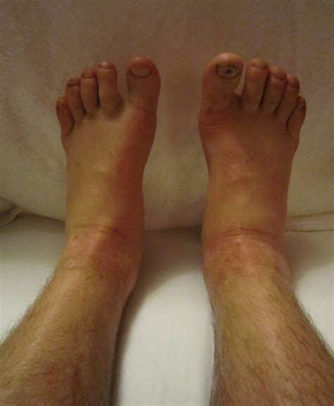 Causes of MILD vs. Severe Bilateral Ankle Swelling » Scary Symptoms