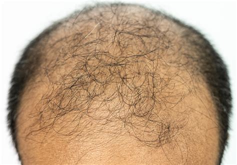 close   top view  baldness mens scalp baldness  related