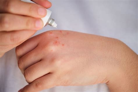 What Causes Itchy Bumps On Palms Of Hands