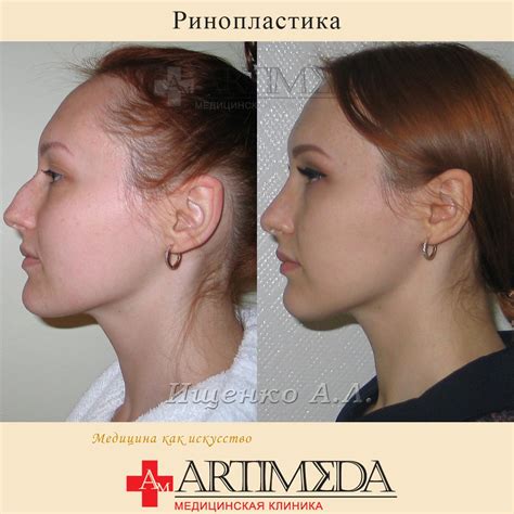 #септопластика hashtag on Twitter