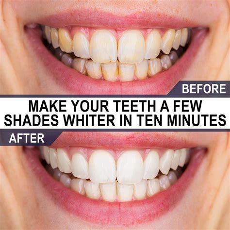 Teeth Whitening Products