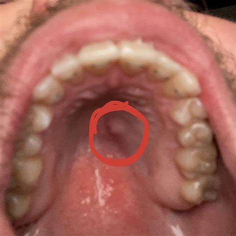 Painful bump on roof of mouth? : r/askadentist