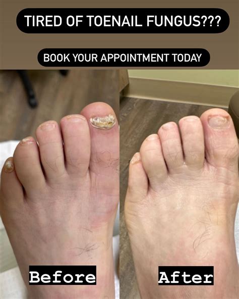 Tired of toenail... - Preferred Foot and Ankle Center, PC