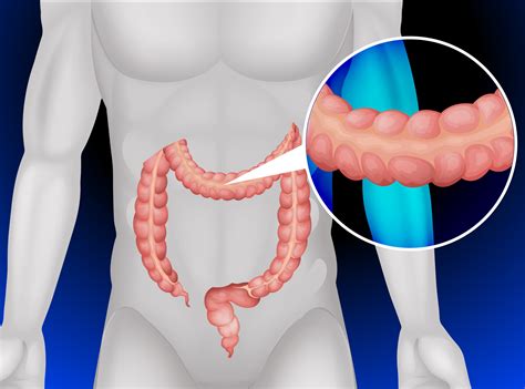 Collagenous Colitis And Lymphocytic Colitis/ Microscopic Colitis