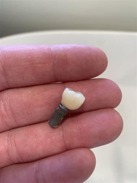 Dental Implant 5 years after extraction. : r/askdentists