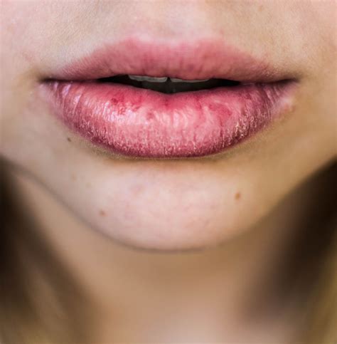 Boca Aspera E Seca - ¿Cómo afecta la “boca seca” tu salud y tus dientes? - Bucco