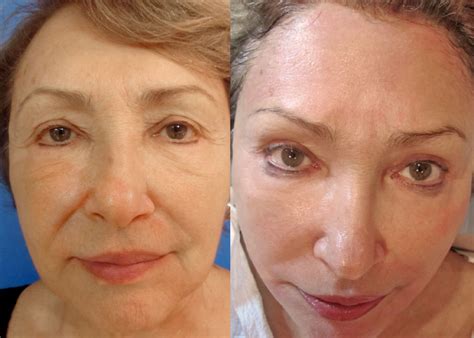 PRP Bio-Facelift in Miami, Florida
