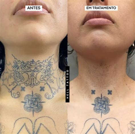 Qual O Valor Para Remover Tatuagem - Quanto Custa Remover uma Tatuagem? Entenda de uma vez!