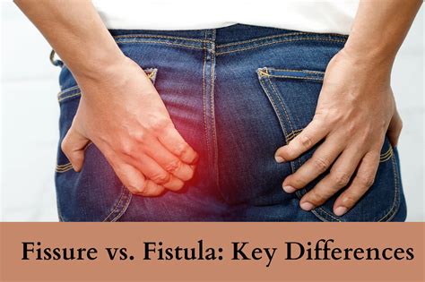 Fissure vs. Fistula: Key Differences | Dr. Abhijit Gotkhinde