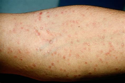 Syphilis | The BMJ