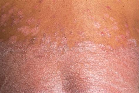 The Back is Full of Psoriasis Stock Image - Image of waste, elderly ...