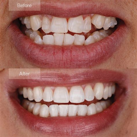 invisalign london ps  clear braces invisalign camden