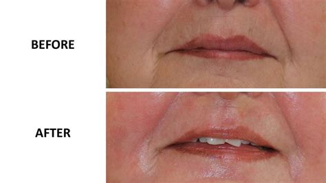 Perioral phenol peel before and after - The Karri Clinic