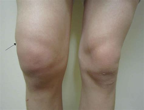 Knee effusion treatment - gilittechno